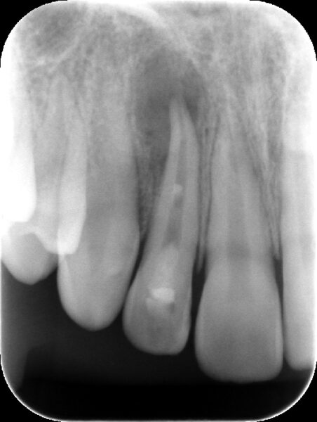 【症例紹介(精密根管治療・根未完成歯)】のアイキャッチ画像