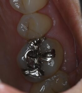 【症例紹介（ダイレクトボンディング）】のアイキャッチ画像