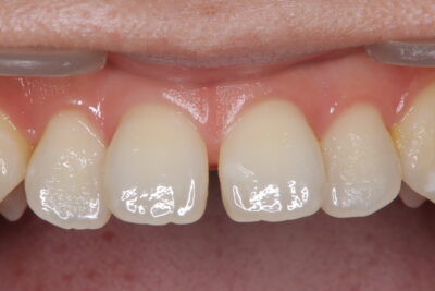 【症例紹介（ダイレクトボンディング・前歯部・すきっ歯）】のアイキャッチ画像