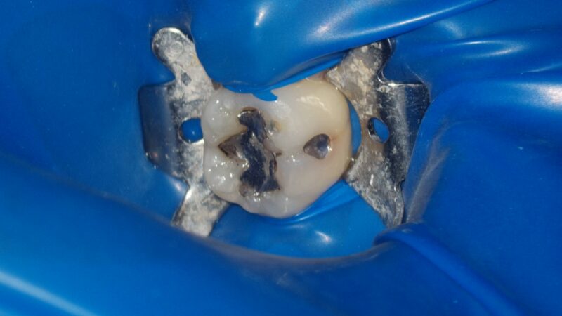 【症例紹介（アマルガム除去・ダイレクトボンディング法）】のアイキャッチ画像